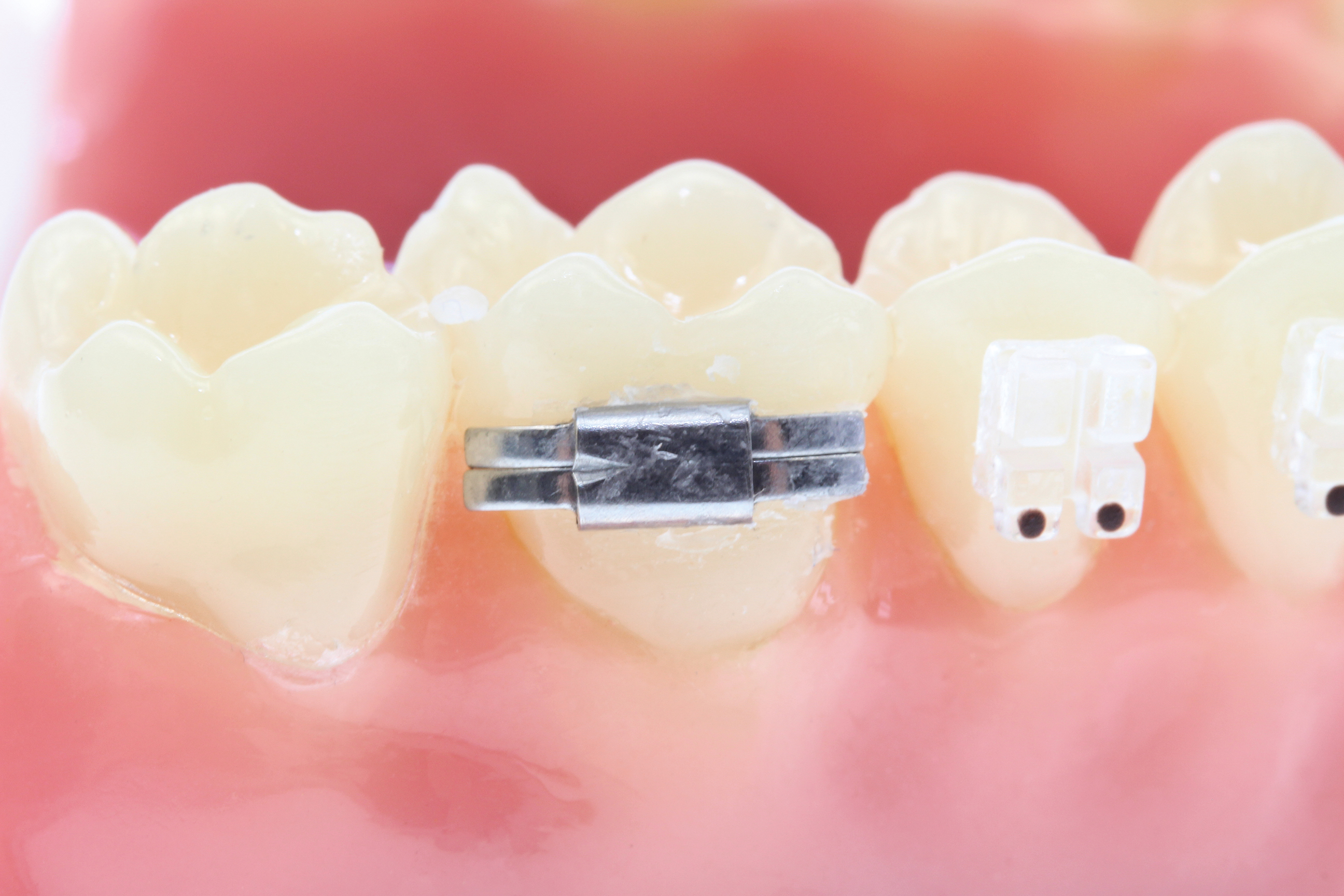 Lingual-Schloß, geschlossen mit Kerbe