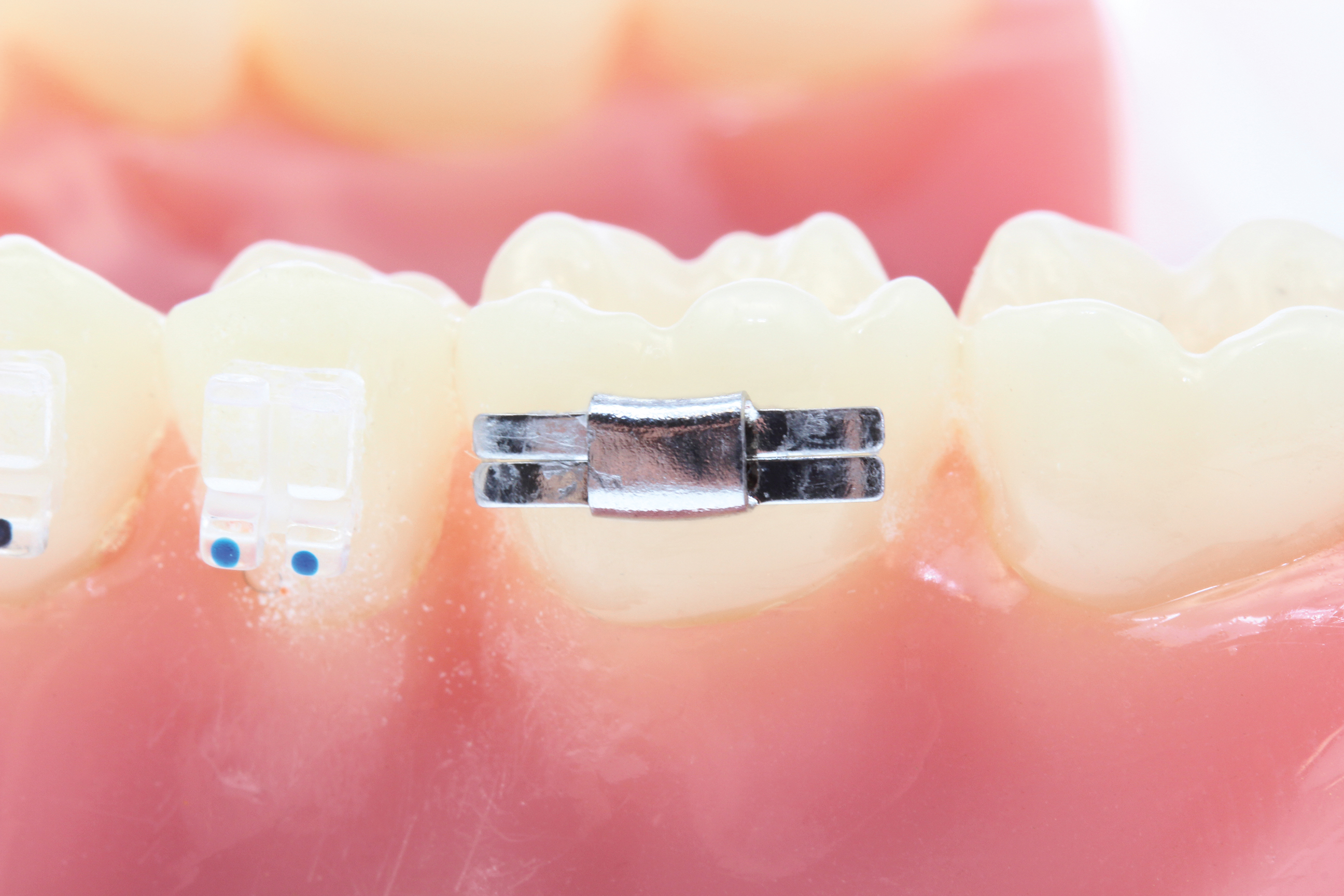 Lingual-Schloß, geschlossen, gebogen