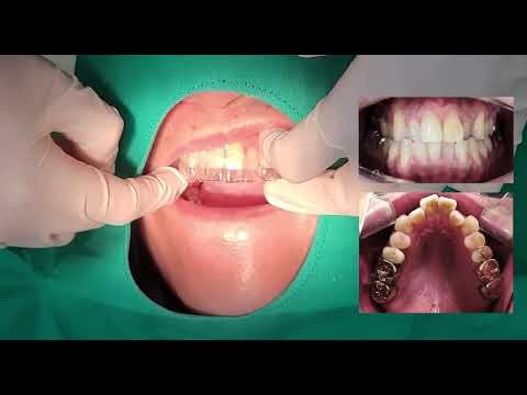 Graphy™ Tera Harz Shape Memory Aligner 3D-Harz